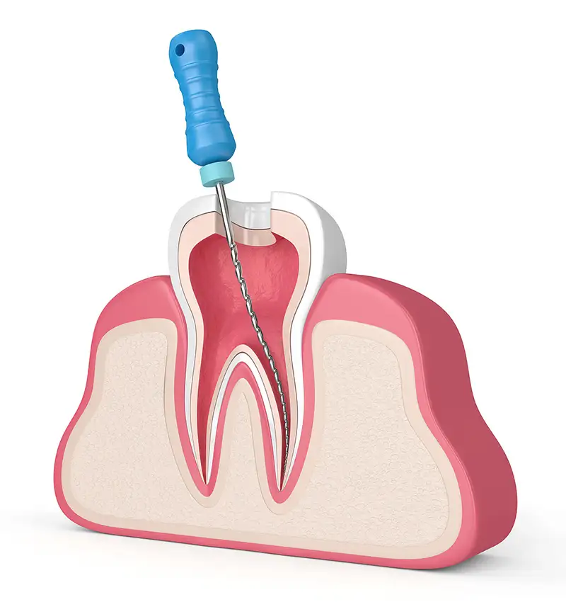 Simply teeth Root Canal