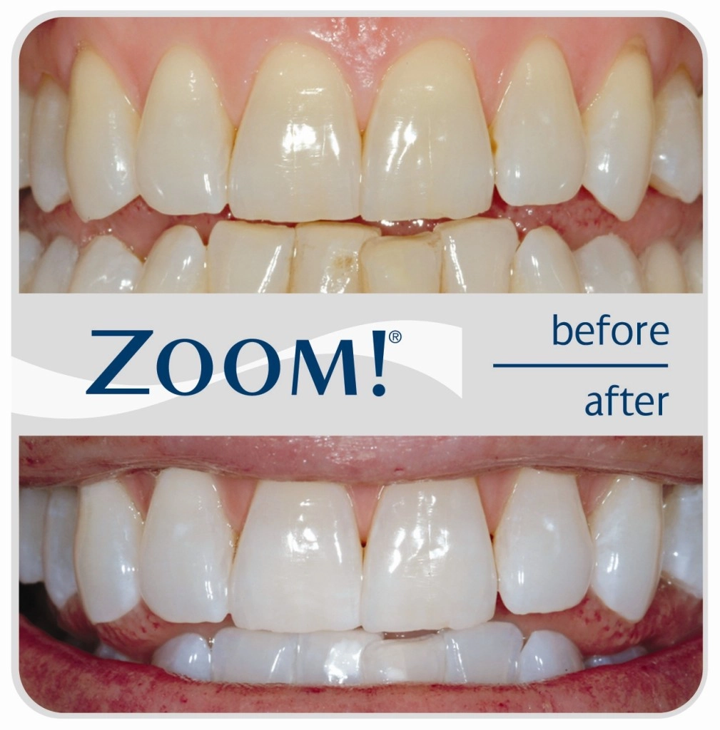 Perthzoom whitening