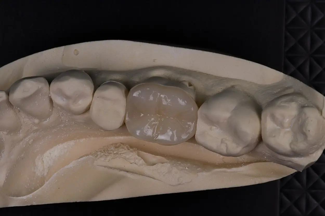 Dental crowns and bridge