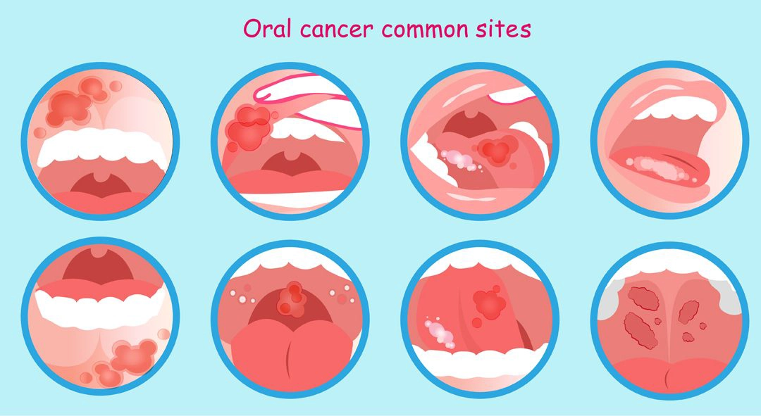 What is oral cancer?