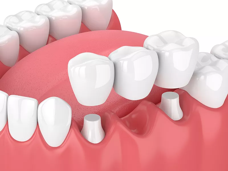 dental corwns and bridges