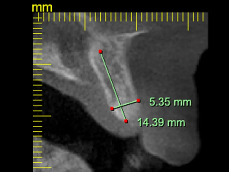 implant cosmetic case study