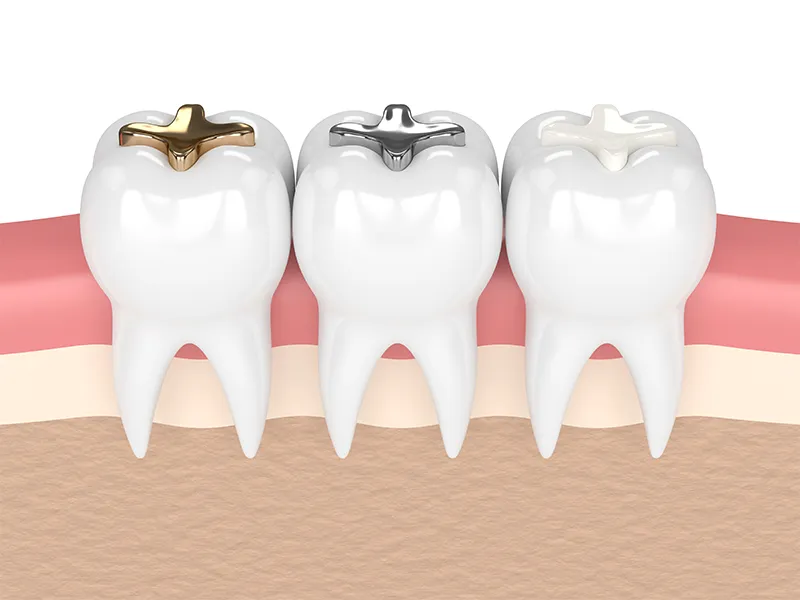 dental fillings