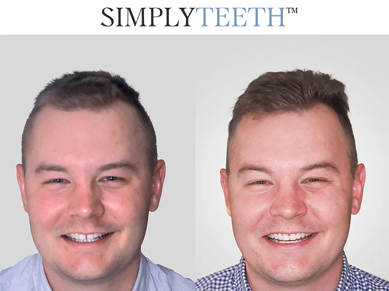 Case Study Invisalign