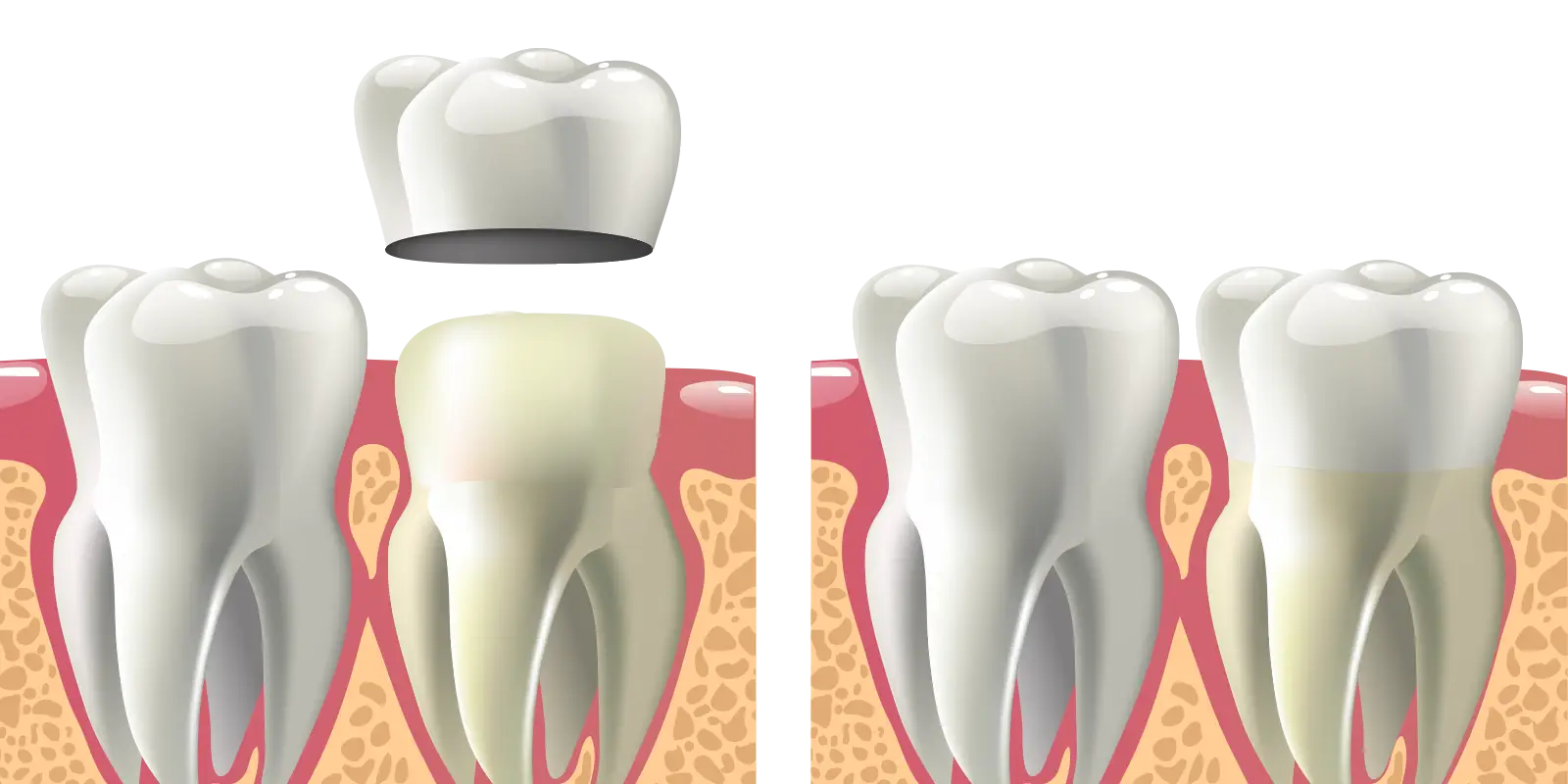 dental crown illustration steps