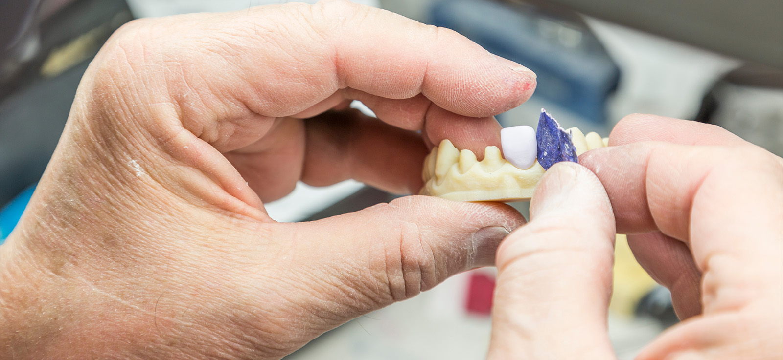 3D-printed dental crown installation