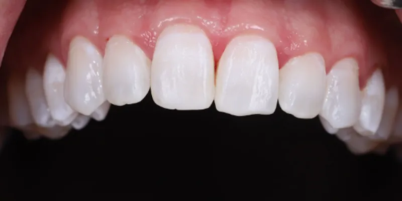 Simply-teeth-resin-infiltration-teeth resin infiltration teeth