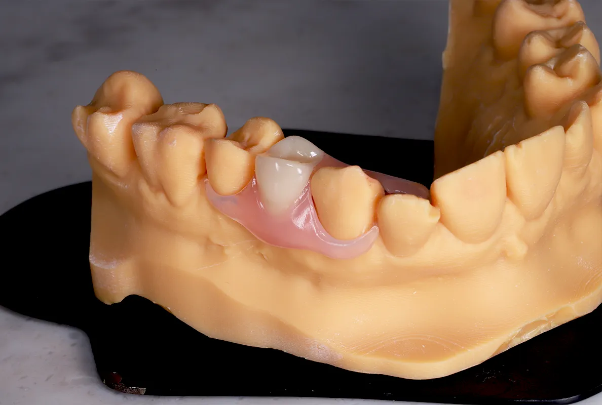 Flexible Partial Dentures