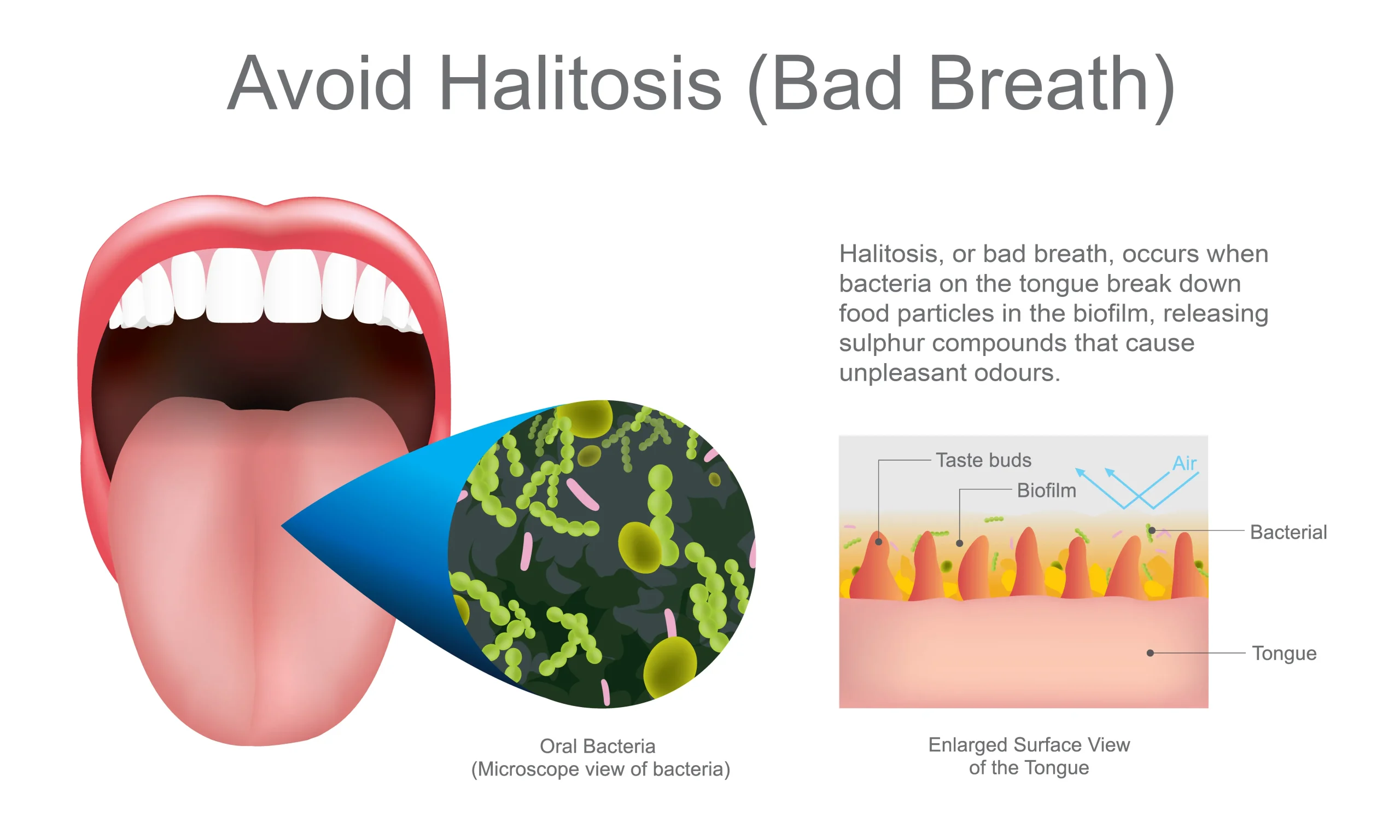 Avoid Halitosis (Bad Breath)