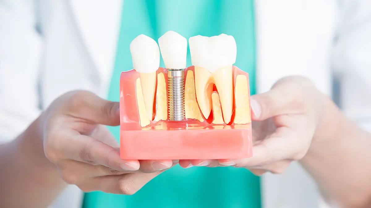 Dental implant solution