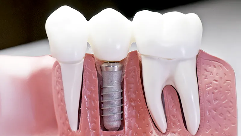 Dental implants Dental implants