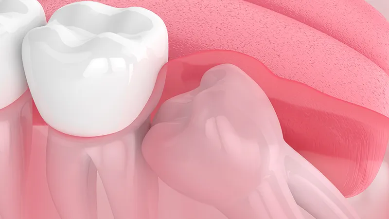 wisdom teeth wisdom teeth
