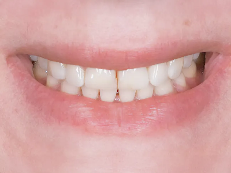 Composite Dentistry Composite Dentistry