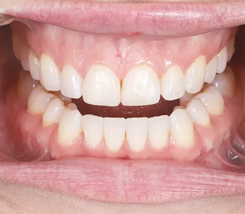 Composite Dentistry Composite Dentistry