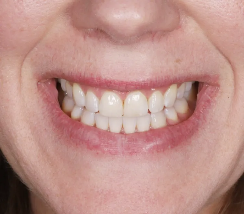 Composite Dentistry Composite Dentistry