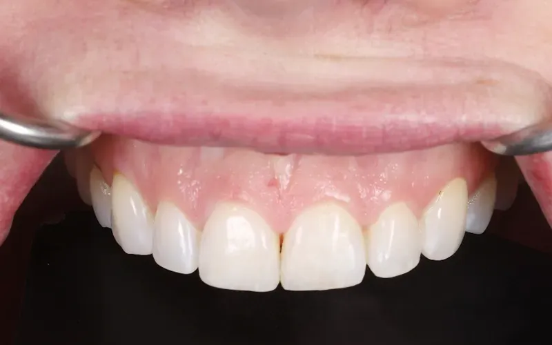 After Composite Restorations After Composite Restorations