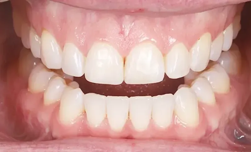 Minimally Invasive Composite Dentistry Minimally Invasive Composite Dentistry