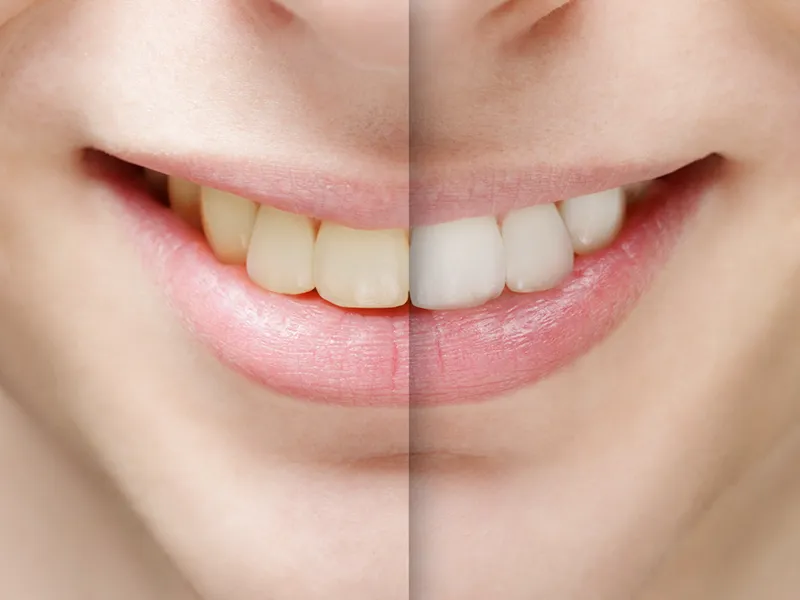 teeth whitening