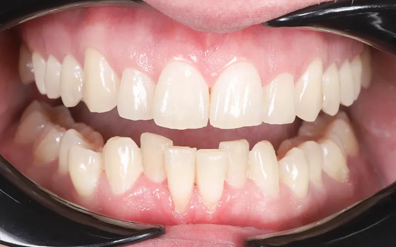 healthy gum healthy gum