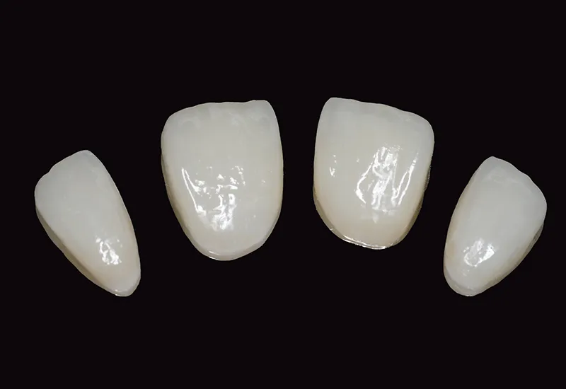 Veneer Replacement Veneer Replacement