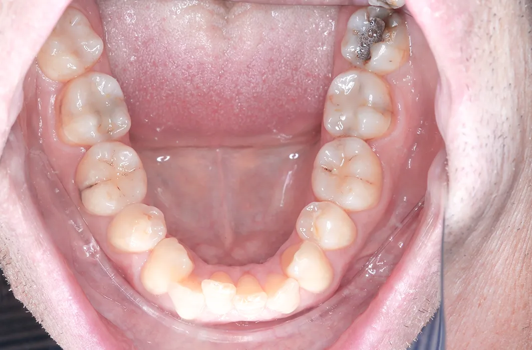 Composite Resin Restorations Composite Resin Restorations