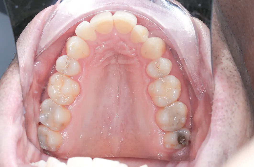 Composite Resin Restorations Composite Resin Restorations