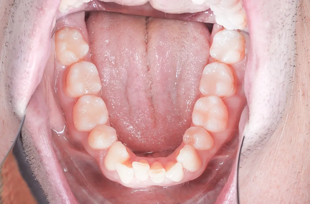 Composite Resin Restorations Composite Resin Restorations