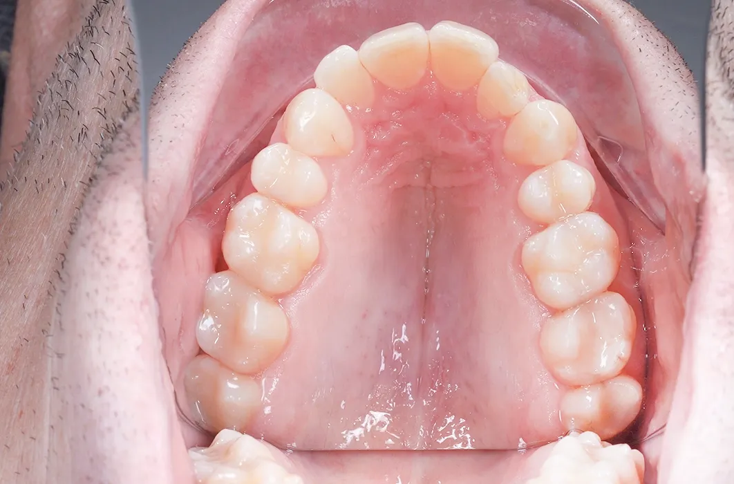 Composite Resin Restorations Composite Resin Restorations