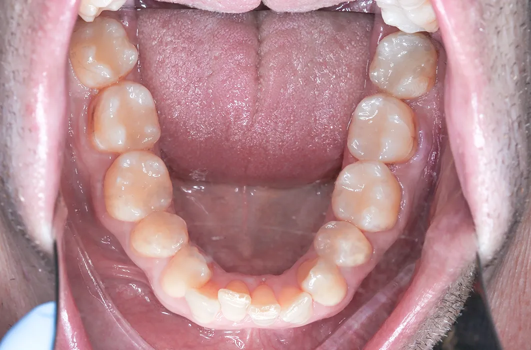 Composite Resin Restorations Composite Resin Restorations