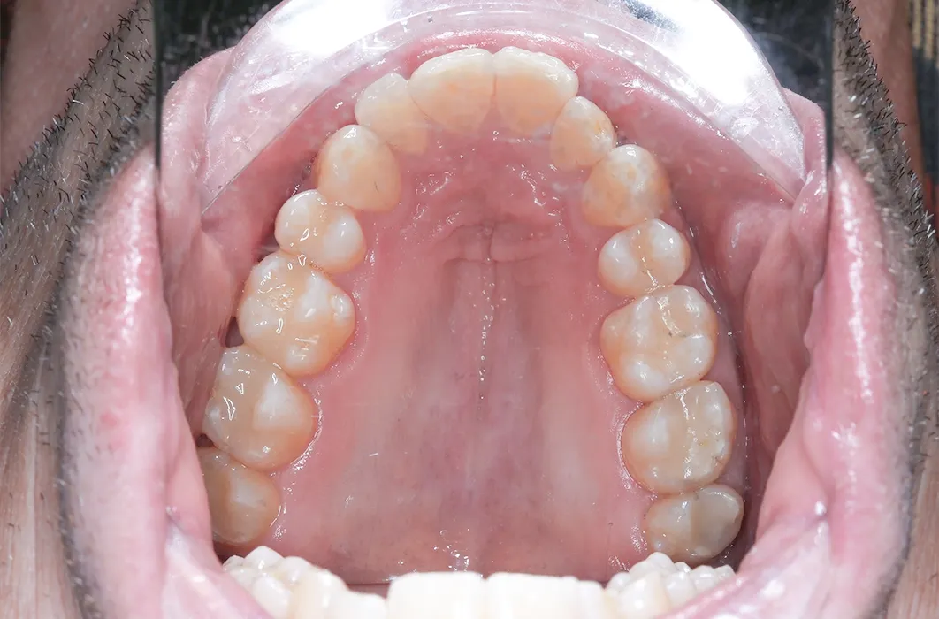 Composite Resin Restorations Composite Resin Restorations