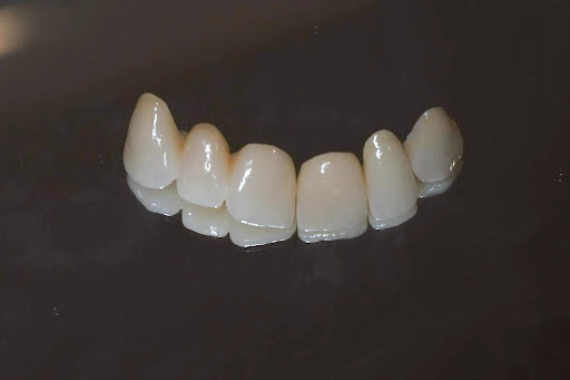 Treatment Approach Bridge Treatment Approach Bridge