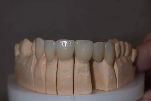 Treatment Approach Bridge Treatment Approach Bridge