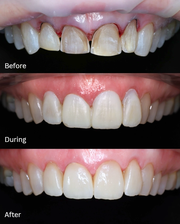 Treatment Process Treatment Process