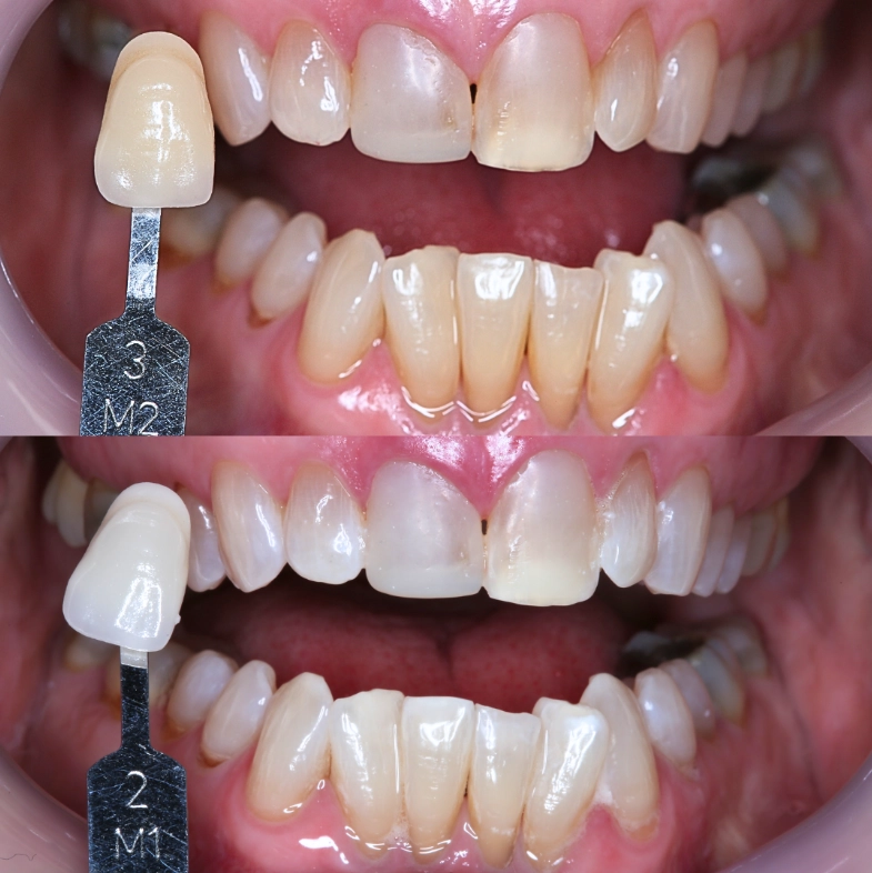 Professional teeth whitening Professional teeth whitening