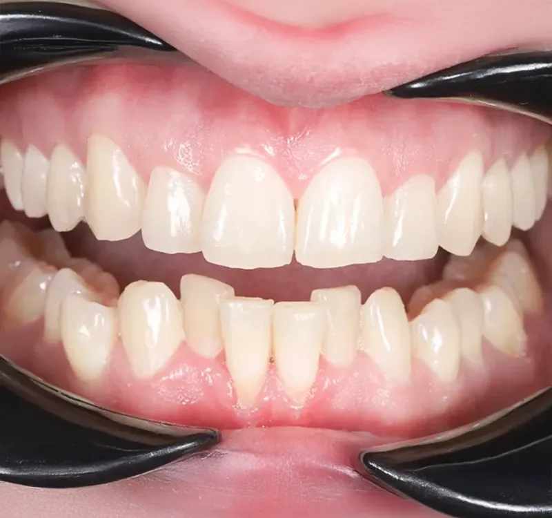 tooth alignment tooth alignment