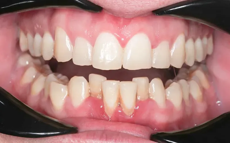 tooth alignment tooth alignment