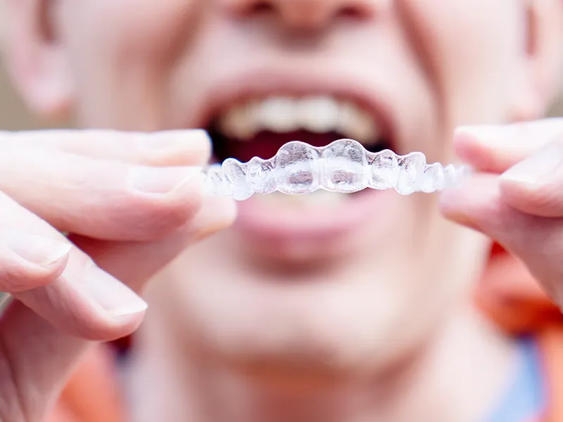 Invisalign treatment plan Invisalign treatment plan