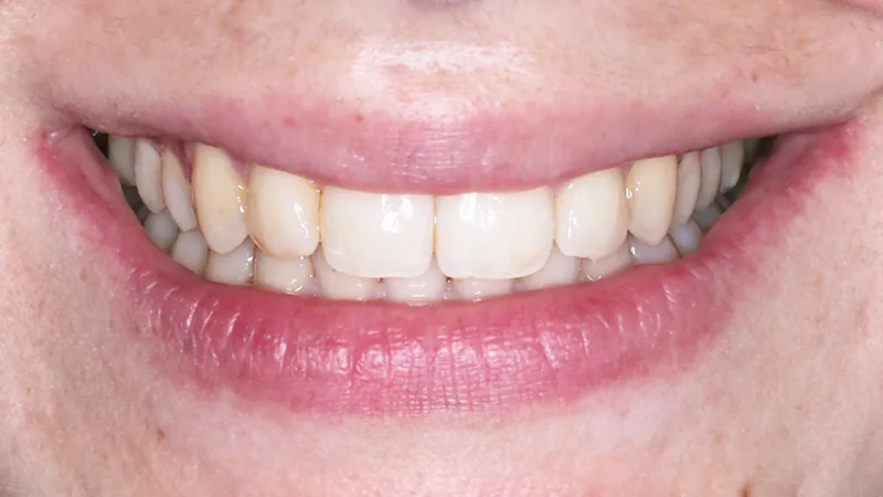 Invisalign for Rotated Lateral Incisors Invisalign for Rotated Lateral Incisors