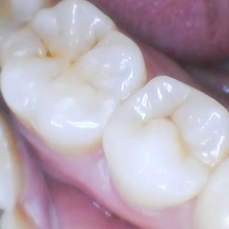 Cavities and surface Cavities and surface