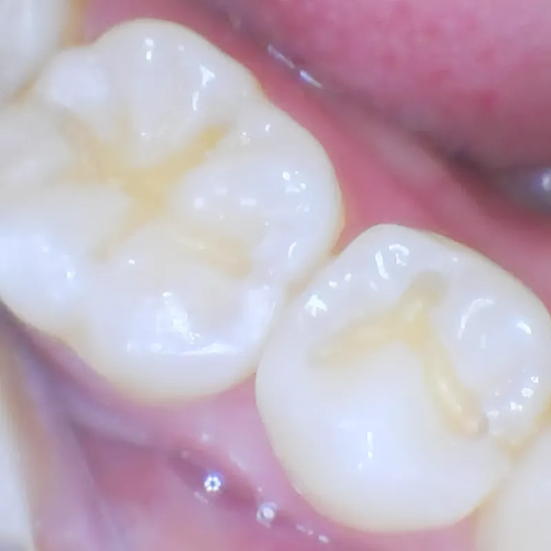 Decay gently removed Decay gently removed