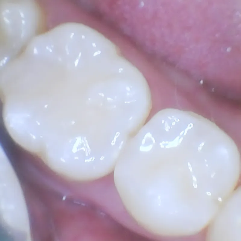 Tooth restored with a bonded Tooth restored with a bonded