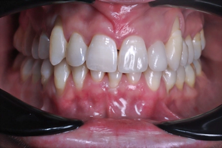 Ceramic restoration on tooth