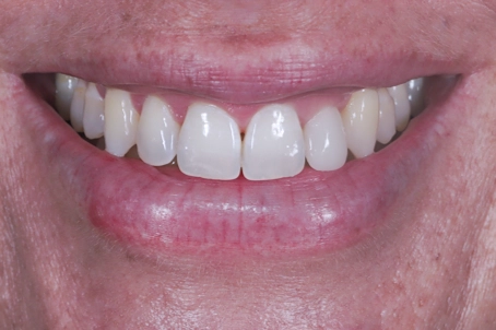 Ceramic restoration on tooth