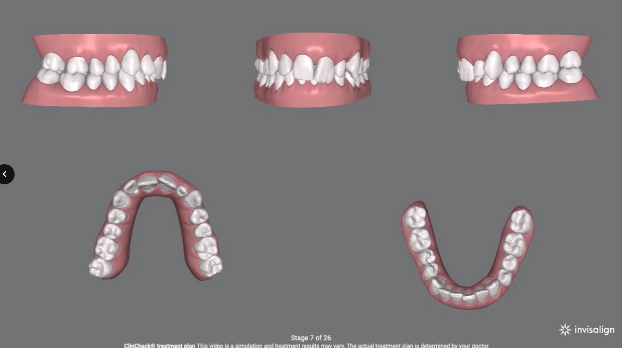 Digital orthodontic planning
