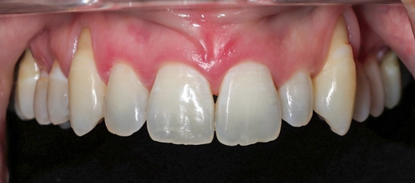 Refining tooth shape