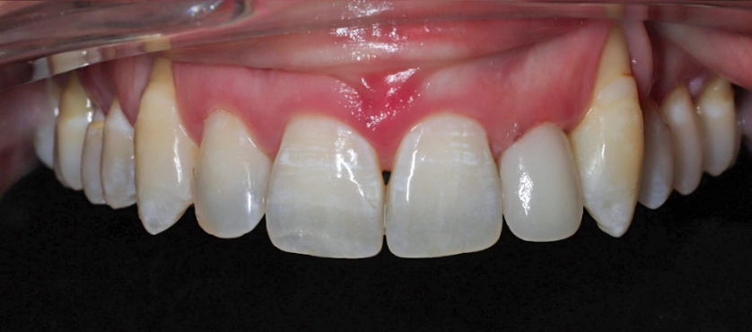 Refining tooth shape