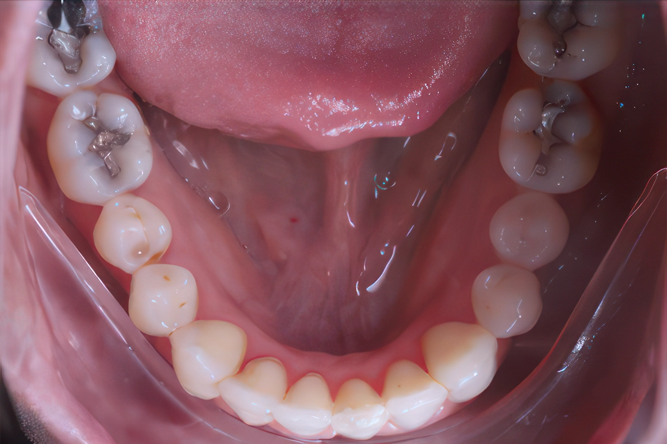 Smile comparison: Before vs after