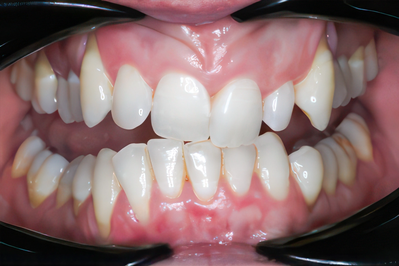 Smile comparison: Before vs after