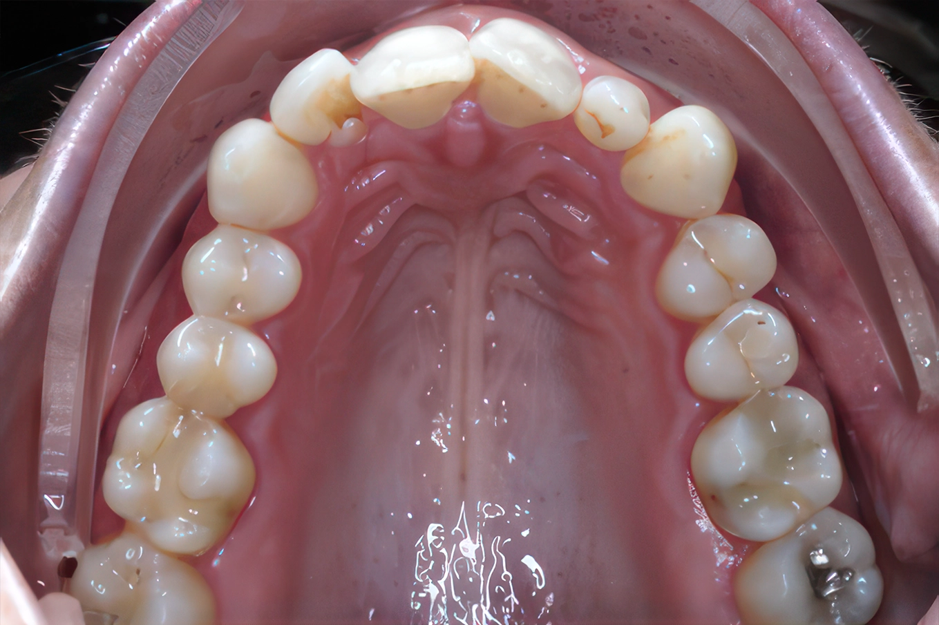 Smile comparison: Before vs after