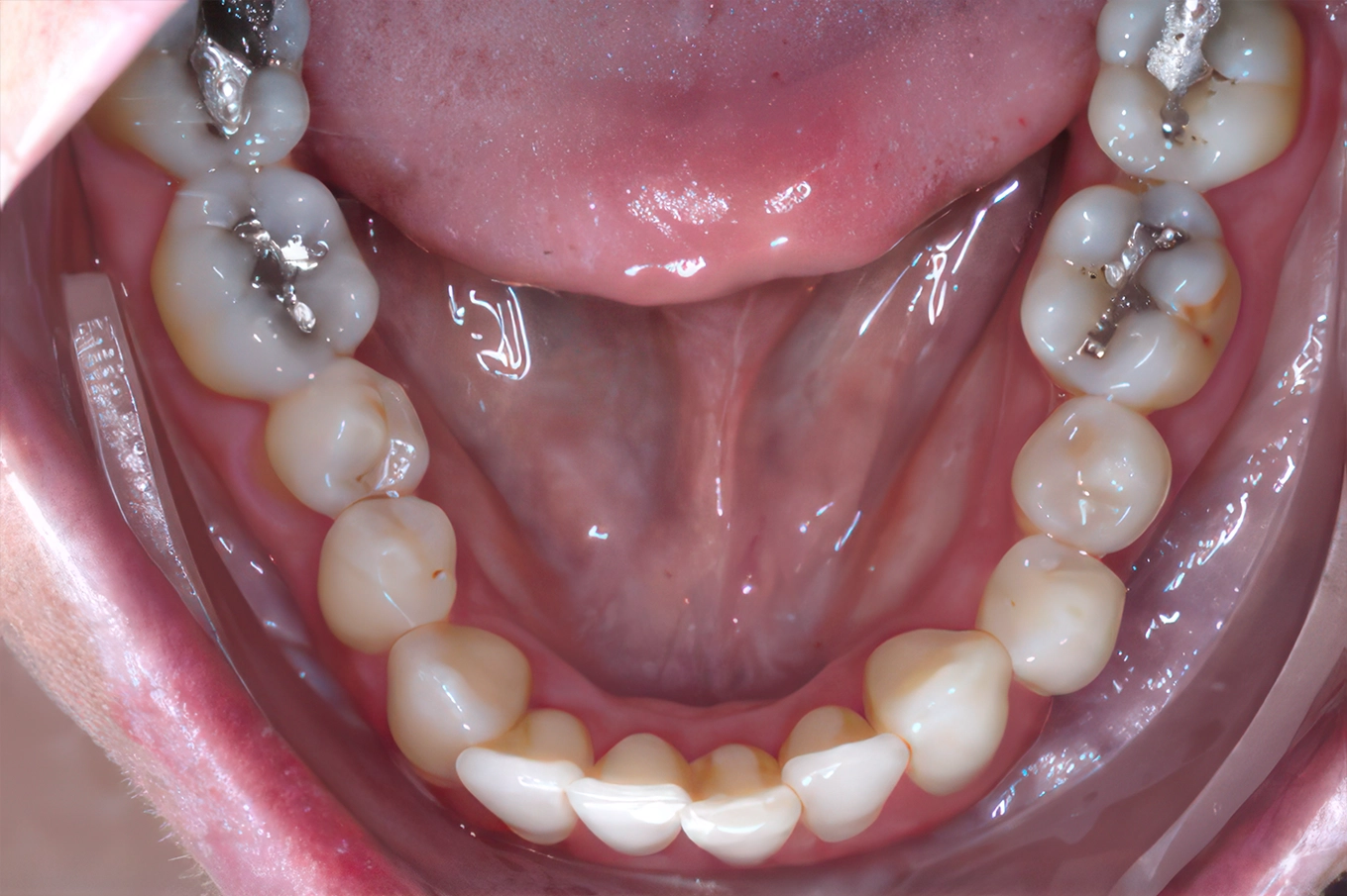 Smile comparison: Before vs after